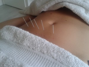 Acupunctuur darmklachten Amsterdam