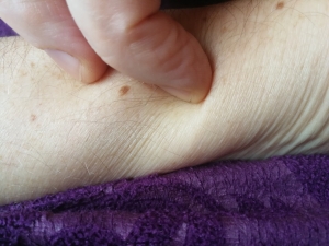 Jeuk – naar de acupuncturist!